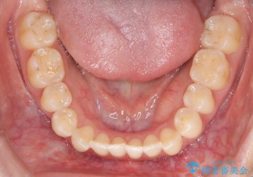 再矯正 前歯のガタツキをマウスピース矯正で治療したいの治療前