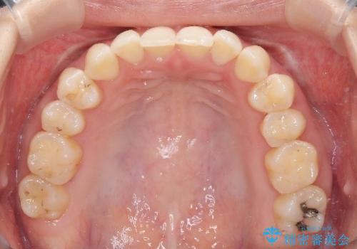 再矯正 前歯のガタツキをマウスピース矯正で治療したいの治療前