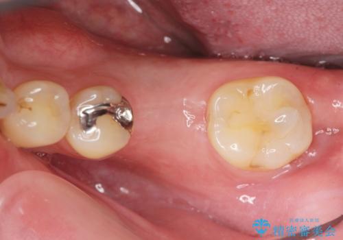 虫歯の再発による抜歯後のインプラント治療の治療中