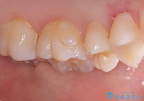 【セラミックインレー】歯が欠けたので治したいの治療後