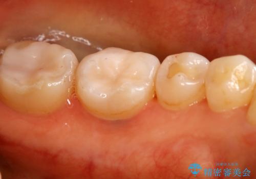 下の奥歯の銀歯を白くしたいの治療後