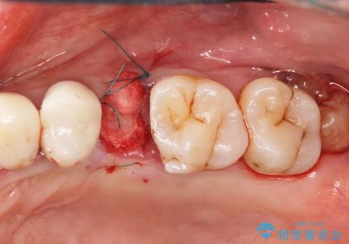 重度歯周病 抜歯後のブリッジ治療の治療中