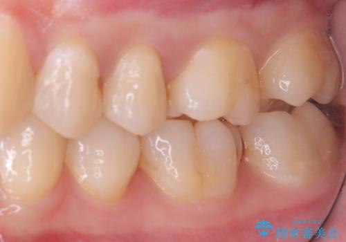 【セラミックインレー】歯が欠けたので治したいの治療前