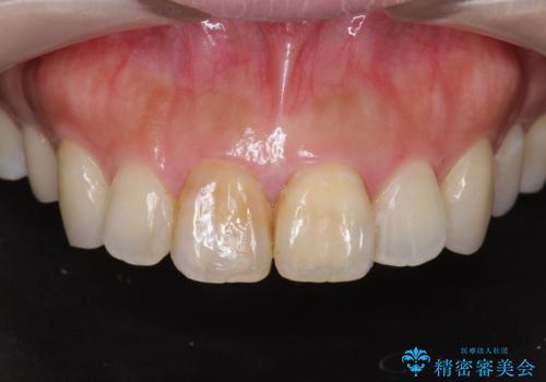 リアルな歯の色調にこだわるオールセラミッククラウン治療の症例 治療前