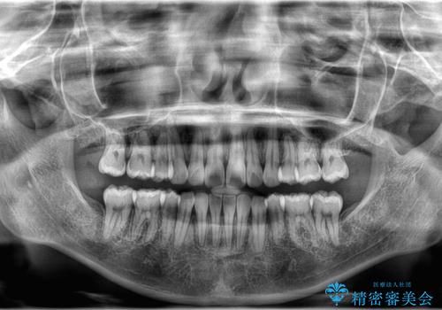 【ワイヤー矯正!】歯のでこぼこと捻じれを治したい!の治療後