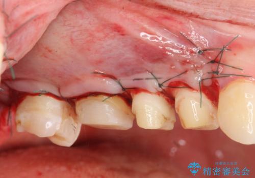 歯周外科を行い歯ぐきの整備を行うセラミック治療の治療中