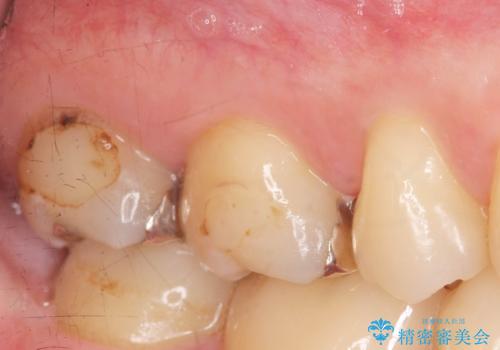 メタルフリー治療 銀歯を全て除去したいの治療前