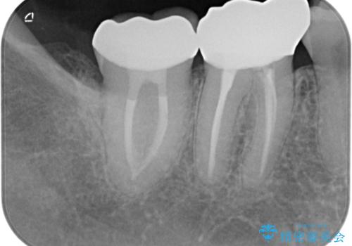 ズキズキ痛い歯　オールセラミッククラウンによる修復の治療後