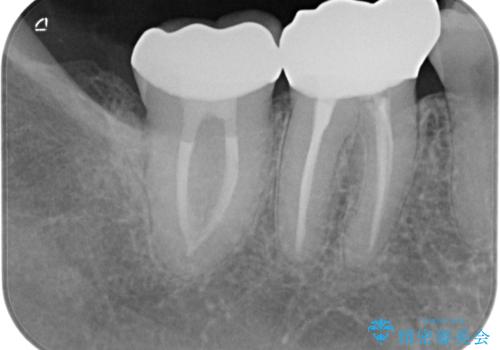 ズキズキ痛い歯 オールセラミッククラウンによる修復の治療後