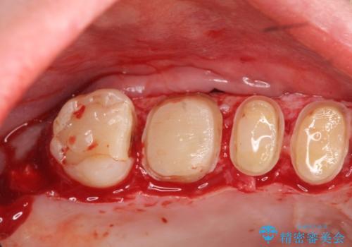 歯周外科を行い歯ぐきの整備を行うセラミック治療の治療中