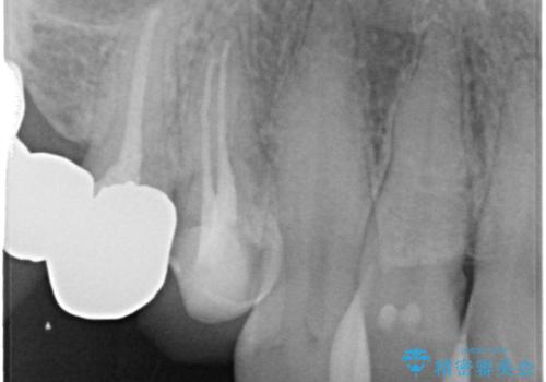 前歯が気になる。ブリッジによる治療。の治療前
