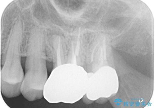 【根管治療】ズーンと痛い歯の治療。の治療後