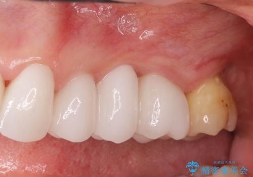 重度歯周病　抜歯後のブリッジ治療の治療後