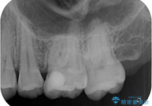 歯に穴が開いた　セラミックインレー修復の治療後