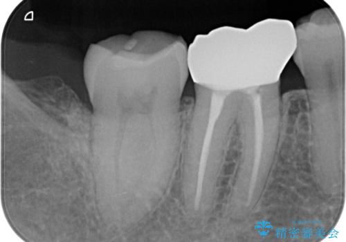 ズキズキ痛い歯 オールセラミッククラウンによる修復の治療前