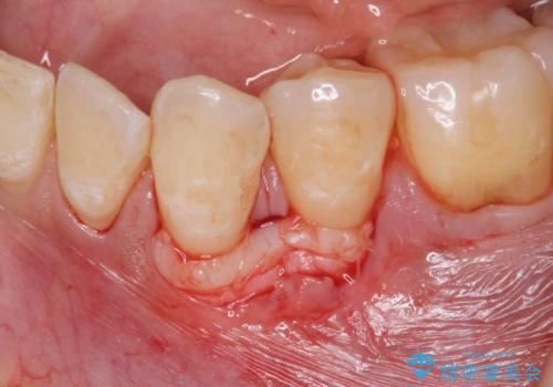 [ 歯ぐきのさがり ]   歯肉退縮に対して行う結合組織移植術の治療中