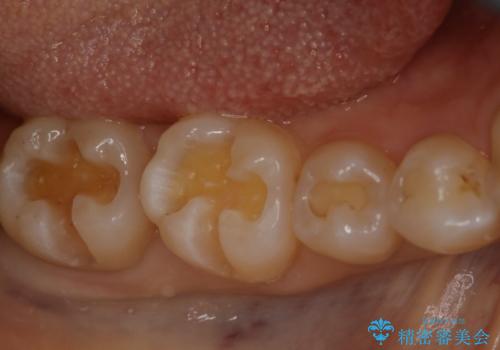奥歯を綺麗にしたいの治療中