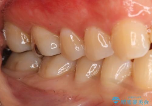 奥歯を綺麗にしたいの治療後
