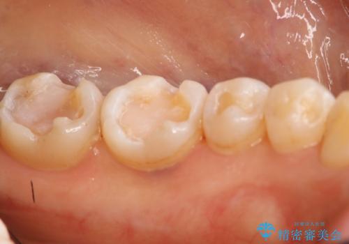 下の奥歯の銀歯を白くしたいの治療中