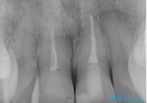 変色した歯を綺麗にしたい 根管治療からジルコニアクラウンでの修復の治療前