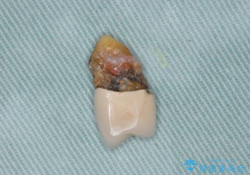 重度歯周病 抜歯後のブリッジ治療の治療中