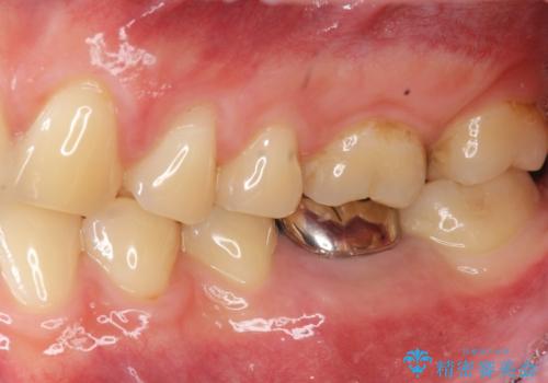 虫歯の再発による抜歯後のインプラント治療の治療前