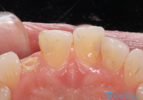 前歯が取れてしまった ジルコニアクラウンでの修復の治療前