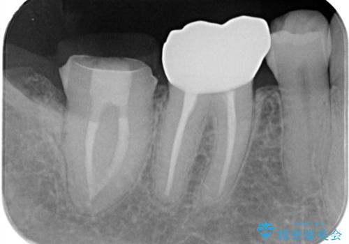 ズキズキ痛い歯 オールセラミッククラウンによる修復の治療中