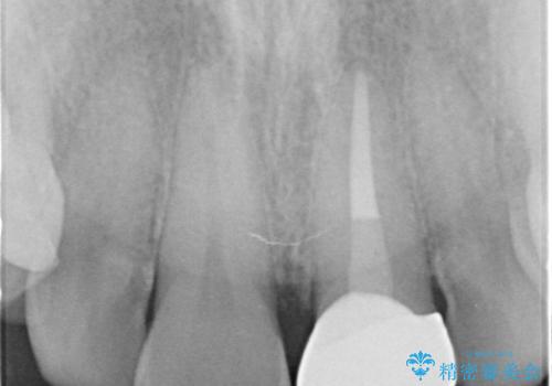 変色した前歯 ジルコニアクラウンでの修復の治療後