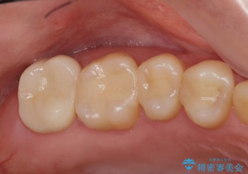 メタルフリー治療 銀歯を全て除去したいの治療後