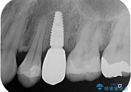 歯が割れてしまった インプラント治療で噛めるように!の治療後