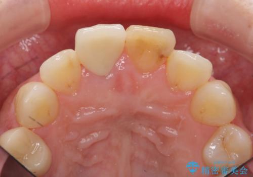 リアルな歯の色調にこだわるオールセラミッククラウン治療の治療後