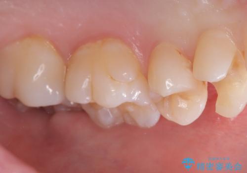 【セラミックインレー】歯が欠けたので治したいの治療中