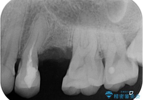 重度歯周病 抜歯後のブリッジ治療の治療中