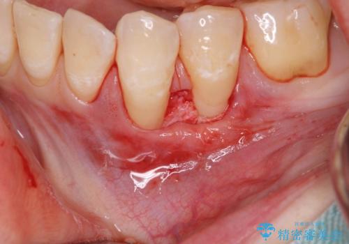[ 歯ぐきのさがり ]   歯肉退縮に対して行う結合組織移植術の治療中