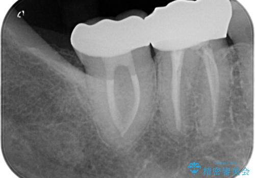 ズキズキ痛い歯 オールセラミッククラウンによる修復の治療後