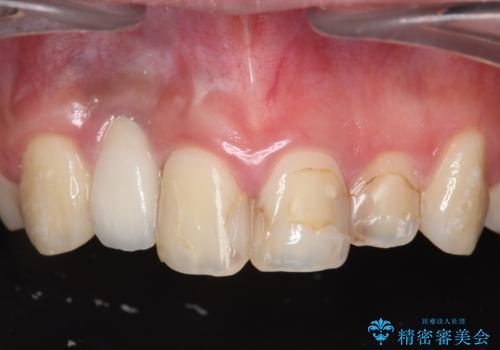 [ 審美歯科治療 ]  充填物でつぎはぎだらけの前歯をセラミックにの症例 治療前
