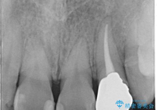 前歯治したい『根管治療 セラミック治療』の治療前
