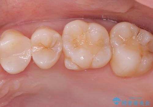 【セラミックインレー】歯が欠けたので治したいの治療後