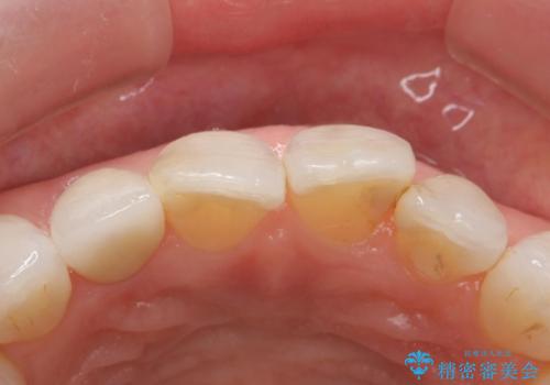 前歯が取れてしまった ジルコニアクラウンでの修復の治療後