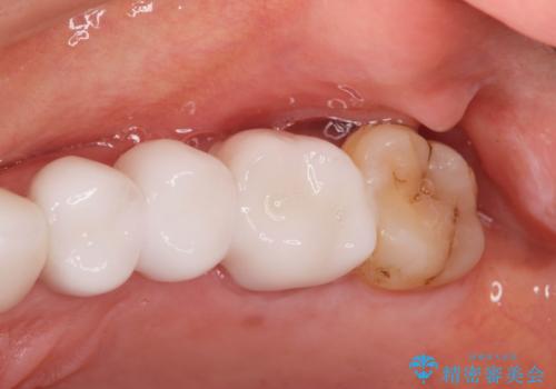 重度歯周病 抜歯後のブリッジ治療の治療後