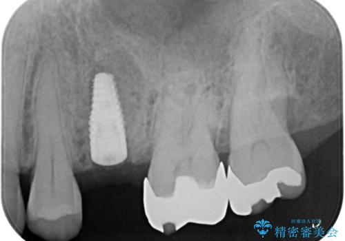 歯茎が腫れる　インプラントでの治療の治療中