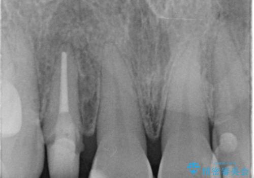 前歯が取れてしまった ジルコニアクラウンでの修復の治療中