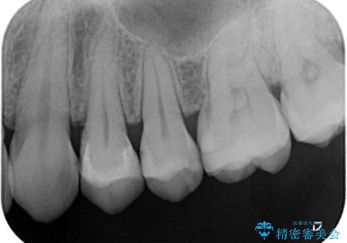 【セラミックインレー】歯が欠けたので治したいの治療後