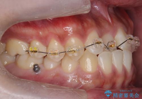 骨格性の受け口の矯正　部分ワイヤーで上の前歯を前に、　マウスピースで下の前歯を後ろに。の治療中