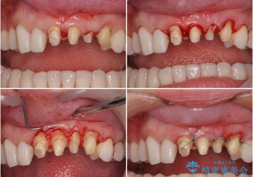 気にしていた歯並びをインビザラインで改善 セラミックも作り替えて綺麗な口元にの治療中