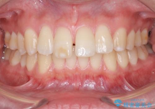 [ インビザライン ]  目立つすきっ歯をマウスピース矯正で改善の症例 治療前
