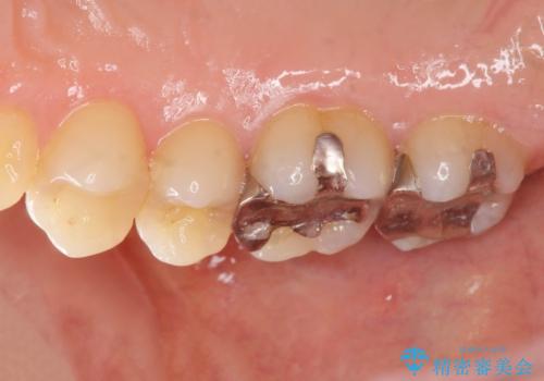 メタルフリー治療 銀歯を全て除去したいの治療前