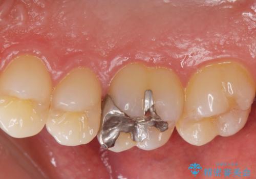 銀歯を白くしたい。の治療前