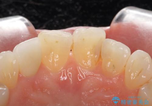 前歯が取れてしまった ジルコニアクラウンでの修復の治療後